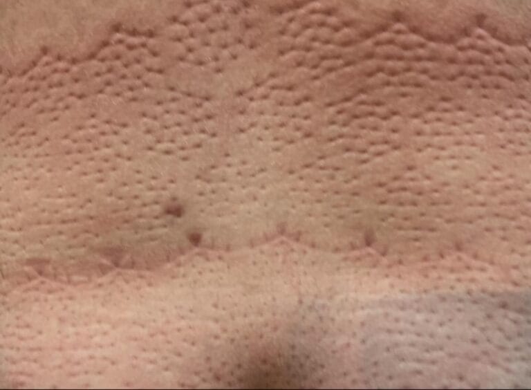 Trigger Points® Acupressure Set photo review