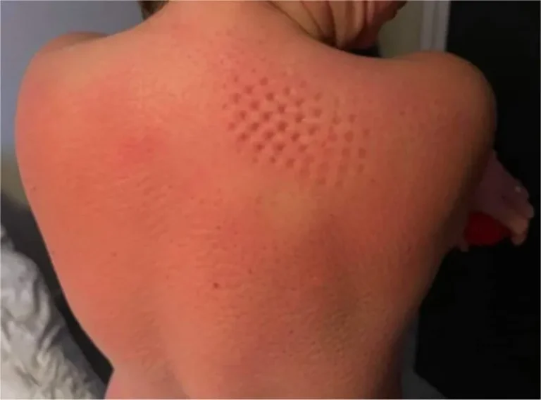 Trigger Points® Acupressure Set photo review