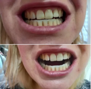 Watersonic - Ultrasonic Teeth Cleaner with Water Cooling photo review